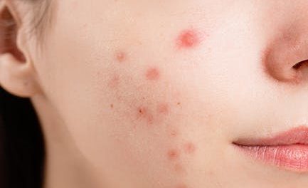 Stop Letting Pimples Restriction Your Way Of Life