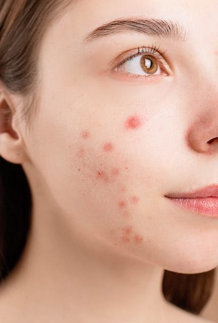 Stop Letting Pimples Restriction Your Way Of Life