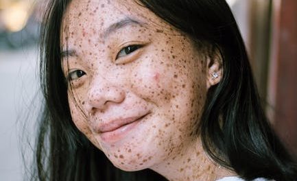 Control Your Pimples In A Few Simple Steps