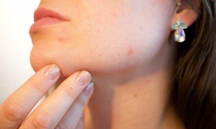 Deal with And Mend Pimples With These Handy Recommendations