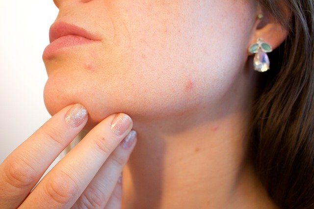 Deal with And Mend Pimples With These Handy Recommendations