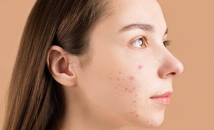 Do Away With Pimples Permanently Using These Suggestions