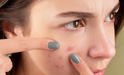 Methods To Get Rid Of Pimples Right now