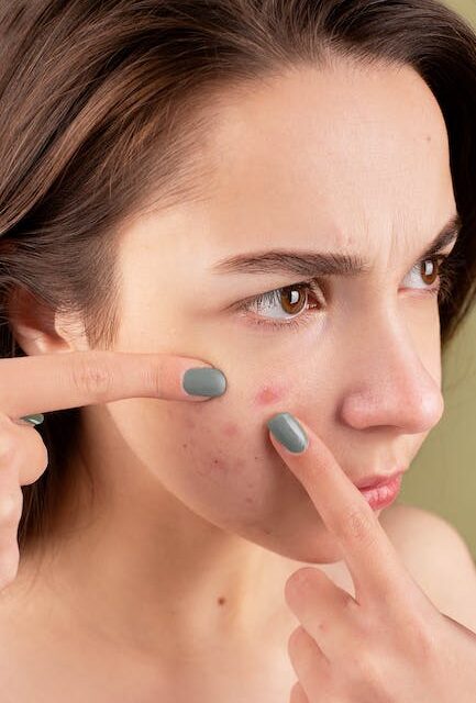 Methods To Get Rid Of Pimples Right now