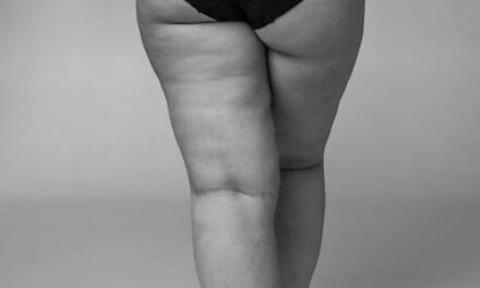 Bothered By Cellulite? Check This Out To Terminate The Aggravation