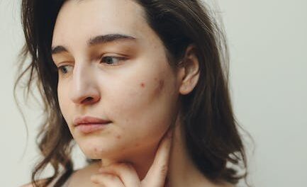 Do You Have Pimples Issues? Try These Guidelines!