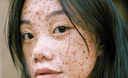 Don’t Let Pimples Damage Your Lifestyle! Consider Looking at These Guidelines!