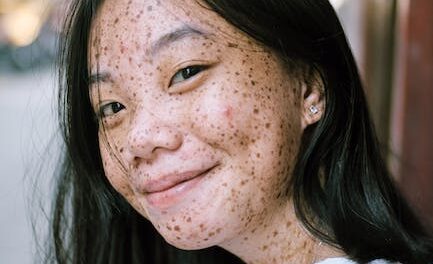 Pimples Might Be Humiliating, Attempt These Ideas To Management It