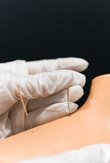 Acupuncture Along With Your Wellness — What You Must Know