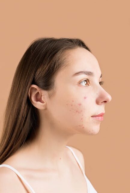 Find Out How To Eliminate Your Pimples