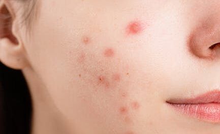 Difficulties With Pimples? Take A Look At These Helpful Ideas!