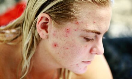 Take Care Of Pimples Issues Using These Ideas