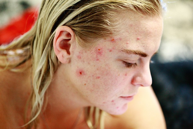 Take Care Of Pimples Issues Using These Ideas